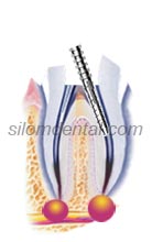 Endodontic Retreatment Procedure