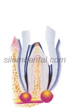 Endodontic Retreatment Procedure
