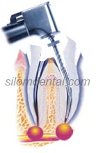 Endodontic Retreatment Procedure