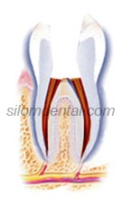 root canal treatment (Endodontics) procedure