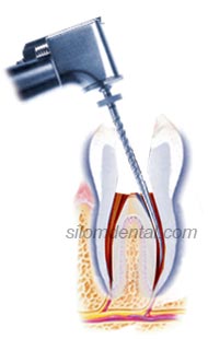 root canal treatment (Endodontics) procedure