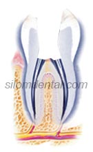 root canal treatment (Endodontics) procedure