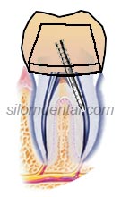 Endodontic Retreatment Procedure