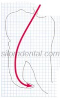 root canal treatment (Endodontics)