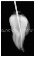 root canal treatment (Endodontics)