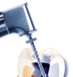 Root Canal Treatment