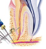 Root Canal Treatment