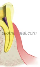 Endodontic surgery Procedure