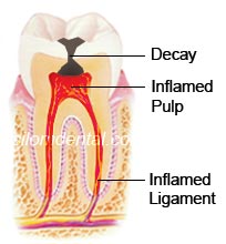 Inflamed tooth