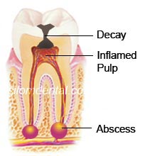 Abscess tooth