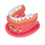 Dental Implant + Bar attachment + Overdenture
