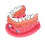 Installing an overdenture on implants