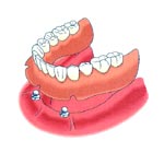 Dental Implant + Ball + Overdenture