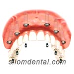 All on 6 + fixed bridge with titanium framework + porcelain in Dental Bangkok, Thailand