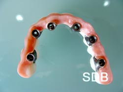 procera implant bridge, hybrid prosthesis