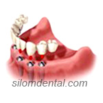 6 Implants + 10 unit Bridges  in Dental Bangkok, Thailand