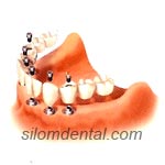 6 Implants + 12 unit Bridges in Dental Bangkok, Thailand