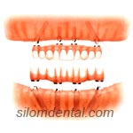 All-on-4 + Overdenture in Bangkok, Thailand