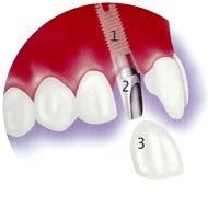 Step of dental implants treatment