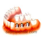 3 Implants & 3 unit bridges in Dental Bangkok, Thailand
