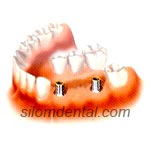 Dental Implants support Bridges