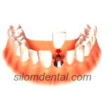 Dental Implant replacment of a single tooth