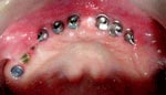 Dental implants replacement of full upper jaw
