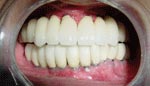 After Dental implants replacement of full upper and lower jaw