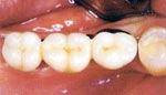 After Dental Implant