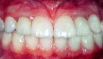 After dental implants replacement of several teeth