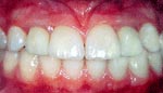 After Dental Implant