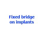 Installing a fixed bridge on implants