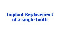 Dental Implant replacment of a single tooth