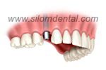 Placing Dental Implants