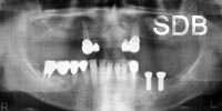 implant replacement of a several teeth