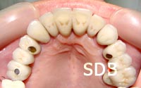 implant replacement of a several teeth