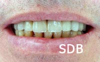implant replacement of a several teeth
