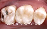 After Dental Inlay