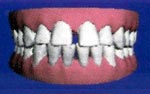 During  Invisalign treatment