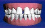 During  Invisalign treatment