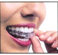 invisalign thailand in dental orthodontics bangkok