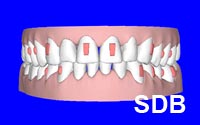 3D clincheck invisalign