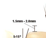 Procera Crown tooth preparation