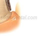 Procera Crown tooth preparation