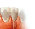 Procera Implant Bridge