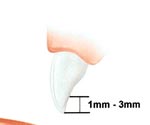 Procera Laminate tooth preparation