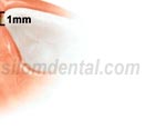 Procera Laminate tooth preparation