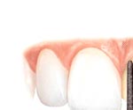 Procera Laminate tooth preparation