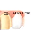 Procera Laminate tooth preparation