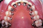 During Lingual Orthodontics